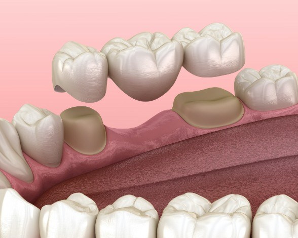 Animated smile during tooth replacement with fixed bridge