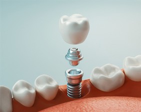 A 3D rendering of a dental implant and its final restoration