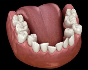 Illustration of crowded teeth