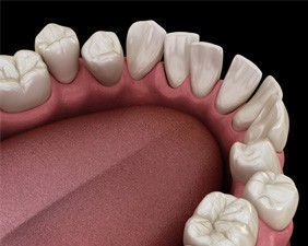 Illustration of gapped teeth